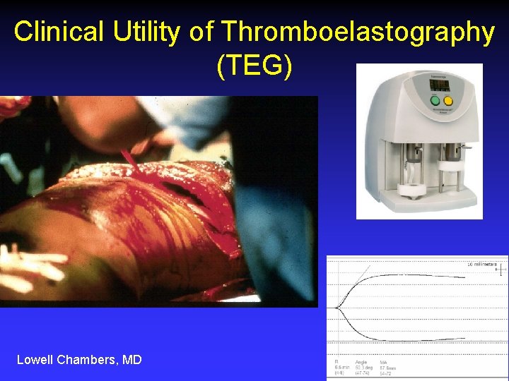 Clinical Utility of Thromboelastography (TEG) Lowell Chambers, MD 