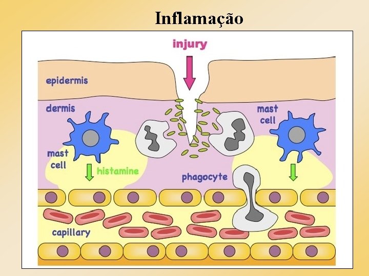Inflamação Inflamação