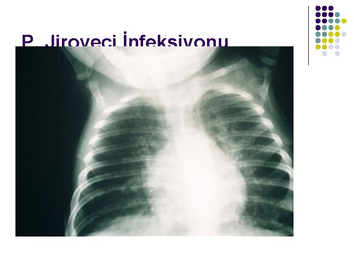 P. Jiroveci İnfeksiyonu 