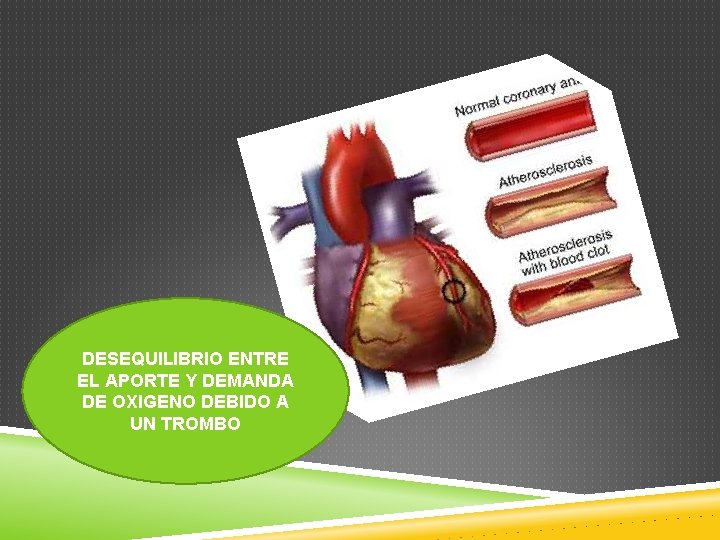 DESEQUILIBRIO ENTRE EL APORTE Y DEMANDA DE OXIGENO DEBIDO A UN TROMBO 