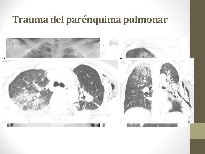 Trauma del parénquima pulmonar 