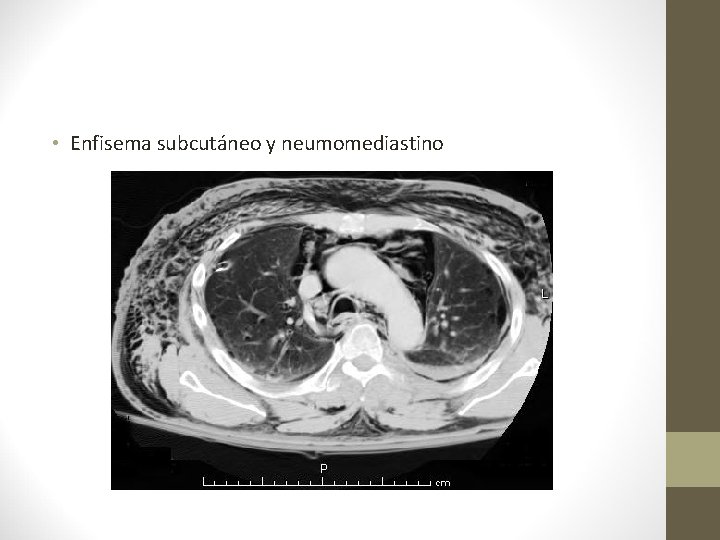  • Enfisema subcutáneo y neumomediastino 