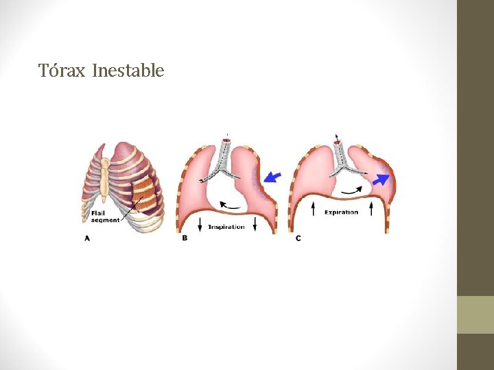 Tórax Inestable 