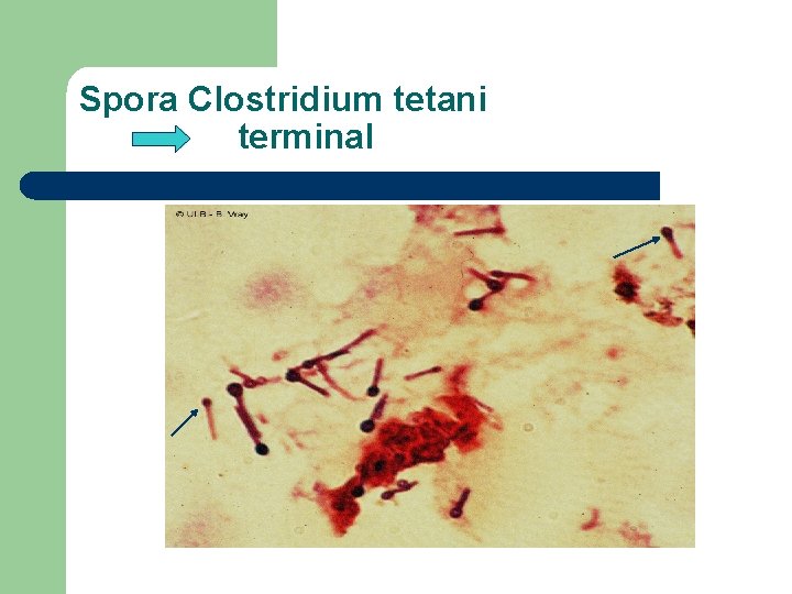 Spora Clostridium tetani terminal 