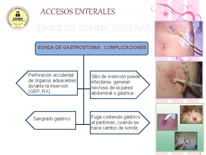 ACCESOS ENTERALES TIPOS DE SONDA ENTERAL SONDA DE GASTROSTOMIA: COMPLICACIONES Perforación accidental de órganos