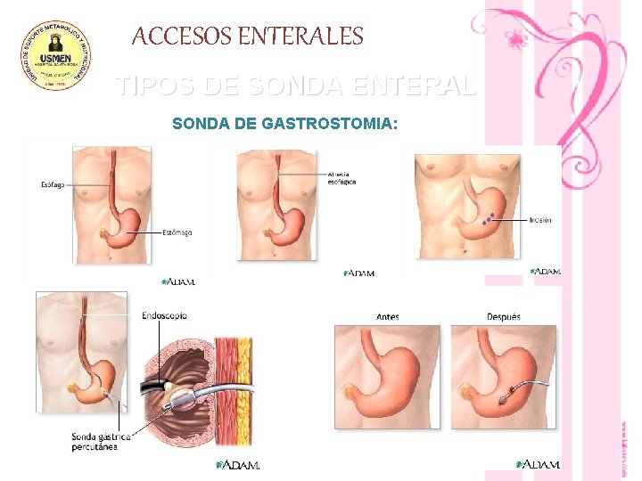 ACCESOS ENTERALES TIPOS DE SONDA ENTERAL SONDA DE GASTROSTOMIA: 