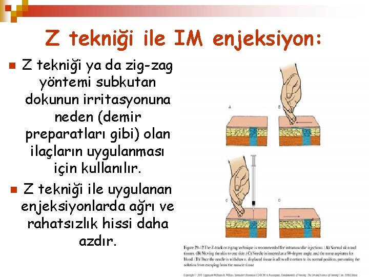 Z tekniği ile IM enjeksiyon: Z tekniği ya da zig-zag yöntemi subkutan dokunun irritasyonuna