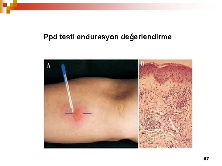 Ppd testi endurasyon değerlendirme 57 