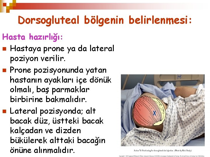 Dorsogluteal bölgenin belirlenmesi: Hasta hazırlığı: n Hastaya prone ya da lateral poziyon verilir. n