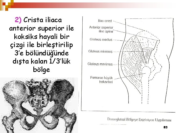 2) Crista iliaca anterior superior ile koksiks hayali bir çizgi ile birleştirilip 3’e bölündüğünde