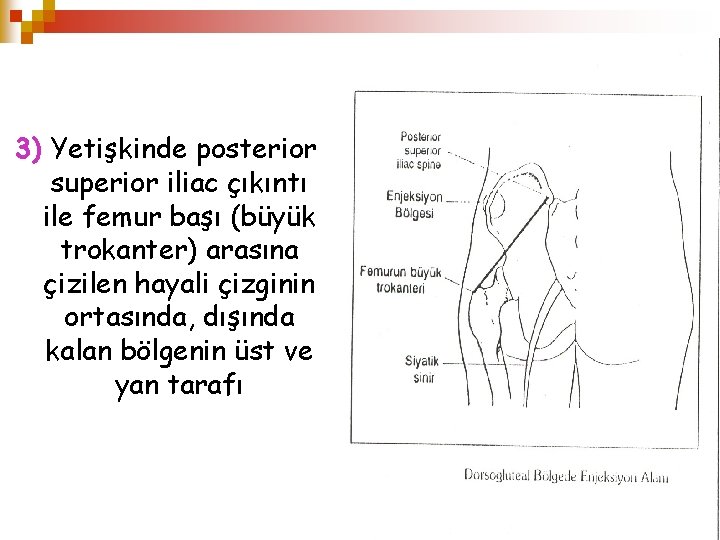 3) Yetişkinde posterior superior iliac çıkıntı ile femur başı (büyük trokanter) arasına çizilen hayali
