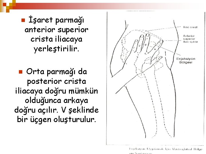 İşaret parmağı anterior superior crista iliacaya yerleştirilir. n Orta parmağı da posterior crista iliacaya