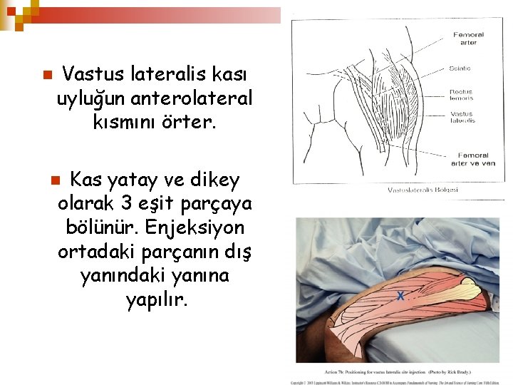 n Vastus lateralis kası uyluğun anterolateral kısmını örter. Kas yatay ve dikey olarak 3