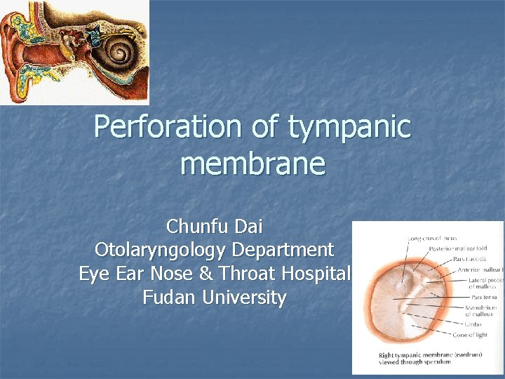 Perforation of tympanic membrane Chunfu Dai Otolaryngology Department Eye Ear Nose & Throat Hospital