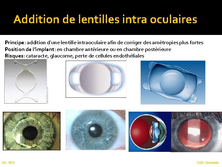 Addition de lentilles intra oculaires Principe: addition d’une lentille intraoculaire afin de corriger des