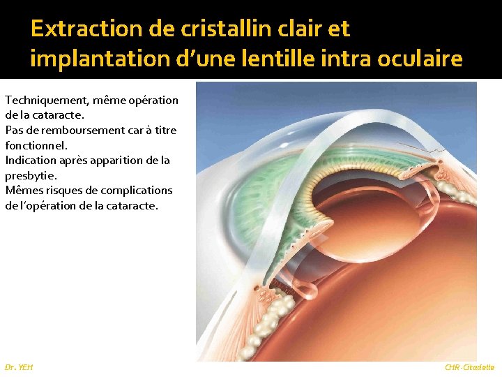 Extraction de cristallin clair et implantation d’une lentille intra oculaire Techniquement, même opération de