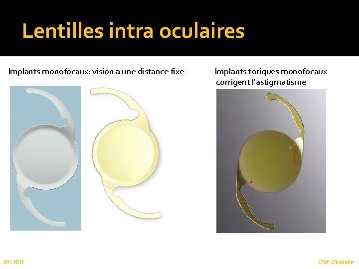 Lentilles intra oculaires Implants monofocaux: vision à une distance fixe Dr. YEH Implants toriques