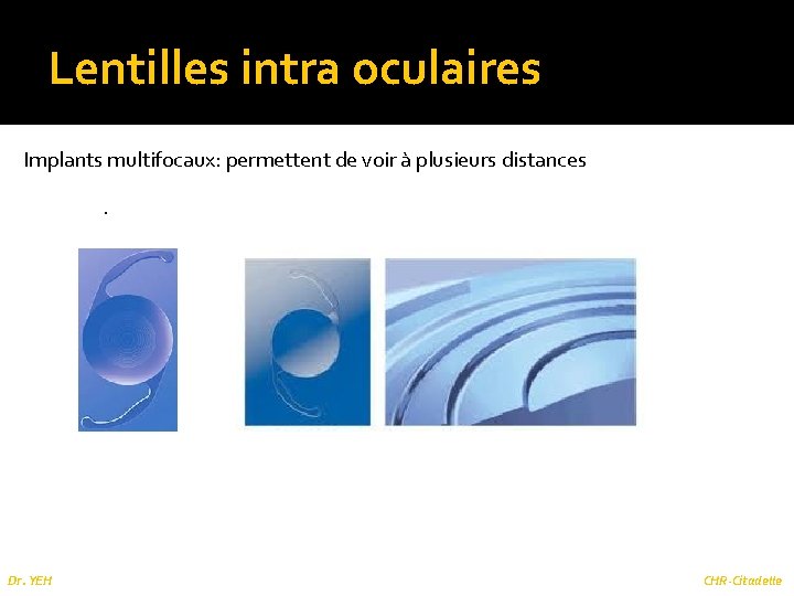 Lentilles intra oculaires Implants multifocaux: permettent de voir à plusieurs distances. Dr. YEH CHR-Citadelle