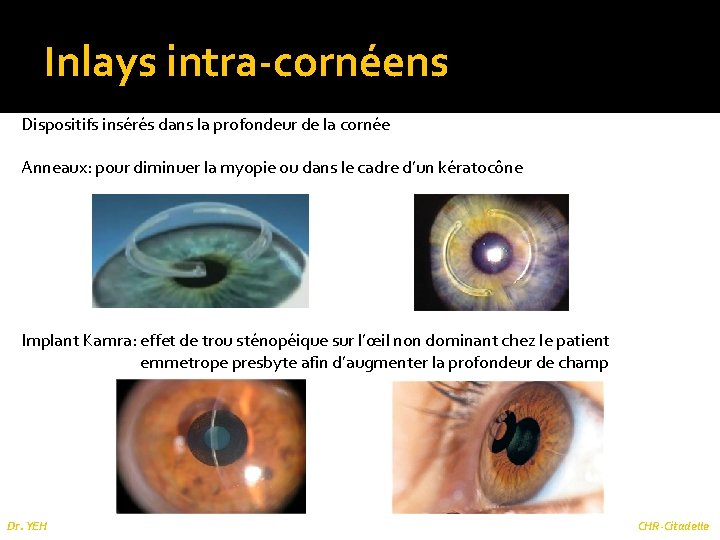 Inlays intra-cornéens Dispositifs insérés dans la profondeur de la cornée Anneaux: pour diminuer la