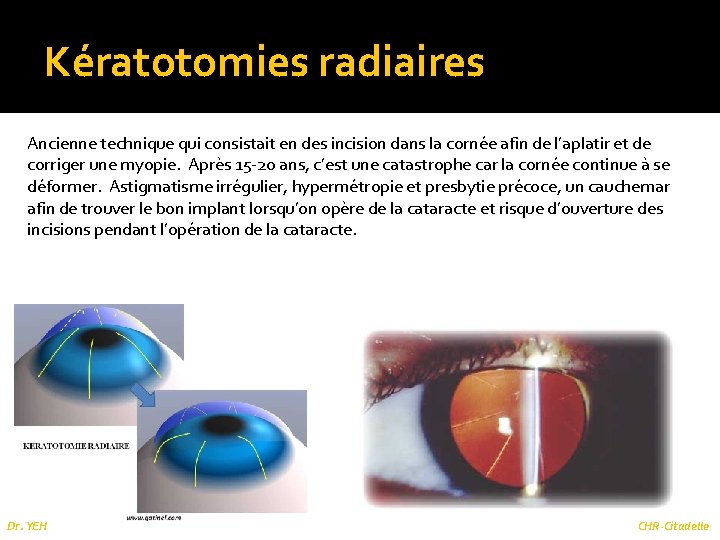 Kératotomies radiaires Ancienne technique qui consistait en des incision dans la cornée afin de