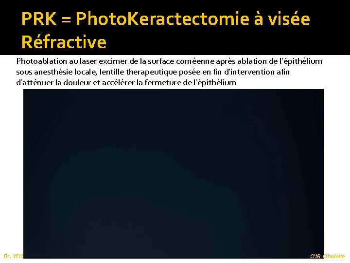 PRK = Photo. Keractectomie à visée Réfractive Photoablation au laser excimer de la surface