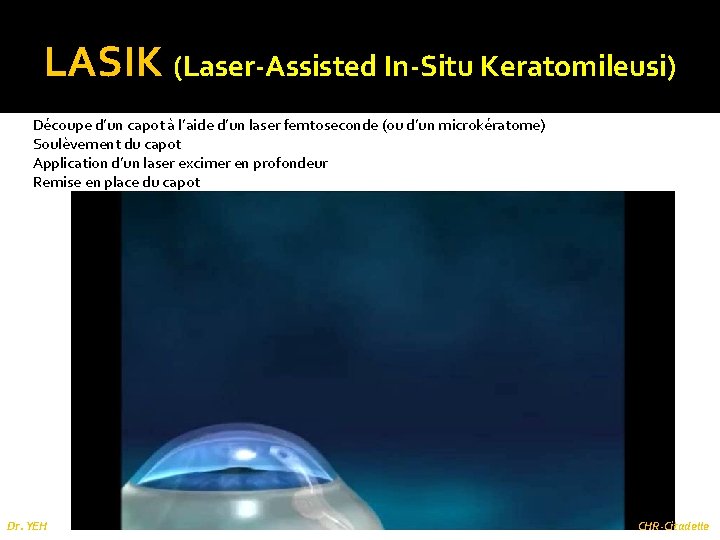 LASIK (Laser-Assisted In-Situ Keratomileusi) Découpe d’un capot à l’aide d’un laser femtoseconde (ou d’un