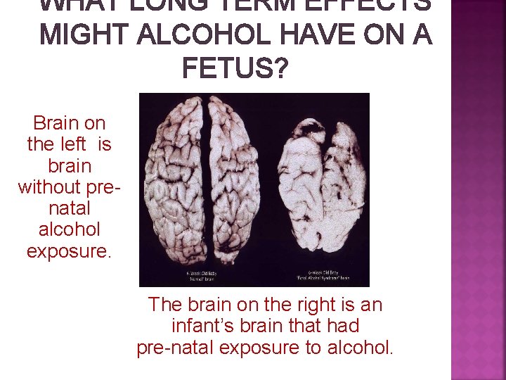 WHAT LONG TERM EFFECTS MIGHT ALCOHOL HAVE ON A FETUS? Brain on the left