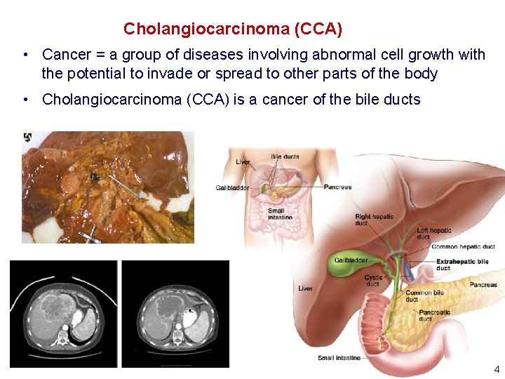 Cholangiocarcinoma (CCA) • Cancer = a group of diseases involving abnormal cell growth with