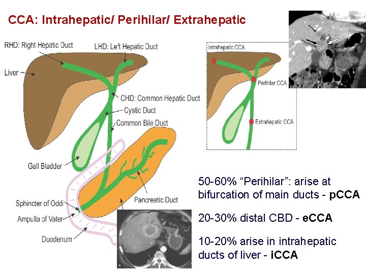 CCA: Intrahepatic/ Perihilar/ Extrahepatic 50 -60% “Perihilar”: arise at bifurcation of main ducts -