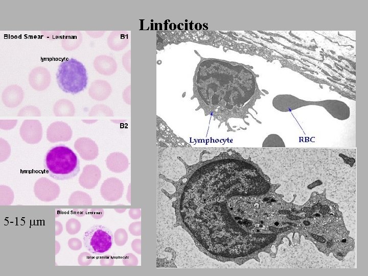 Linfocitos 5 -15 mm 