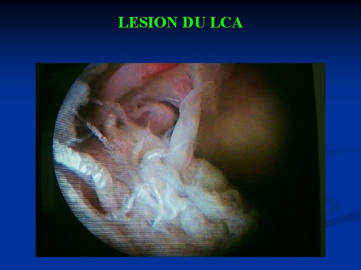 LESION DU LCA 
