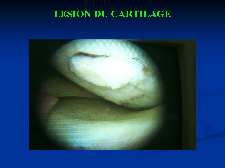 LESION DU CARTILAGE 