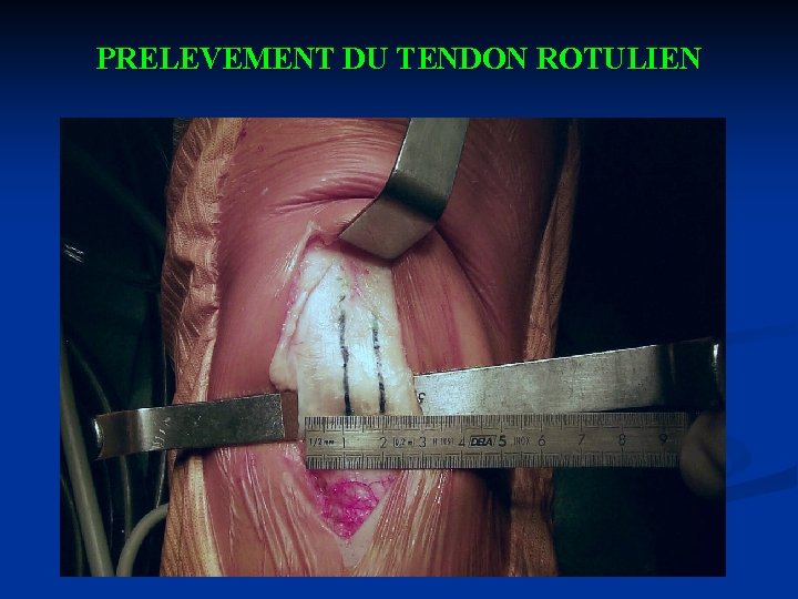 PRELEVEMENT DU TENDON ROTULIEN 