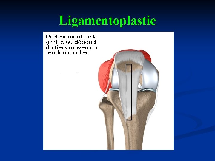 Ligamentoplastie 