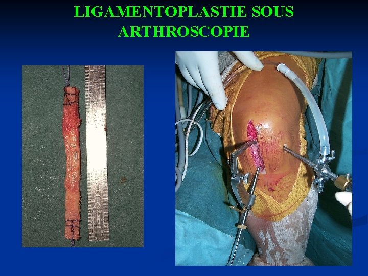 LIGAMENTOPLASTIE SOUS ARTHROSCOPIE 