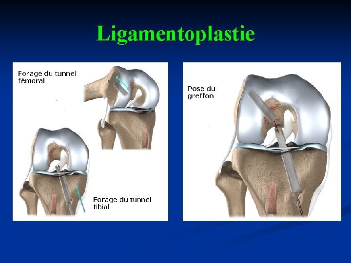 Ligamentoplastie 