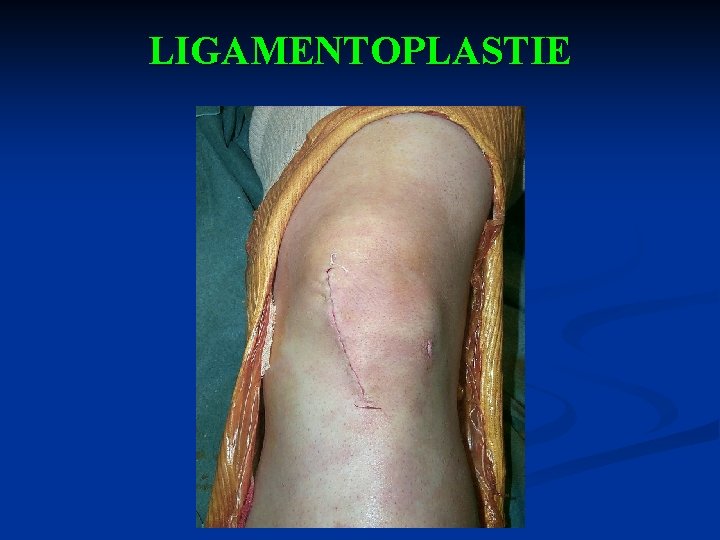 LIGAMENTOPLASTIE 