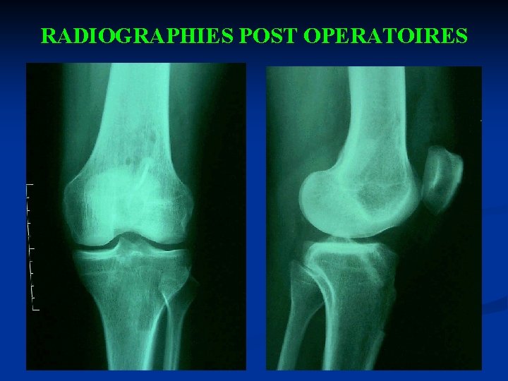 RADIOGRAPHIES POST OPERATOIRES 