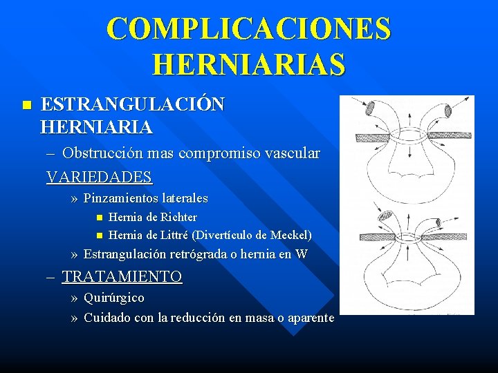COMPLICACIONES HERNIARIAS n ESTRANGULACIÓN HERNIARIA – Obstrucción mas compromiso vascular VARIEDADES » Pinzamientos laterales