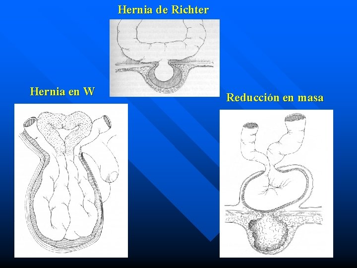 Hernia de Richter Hernia en W Reducción en masa 