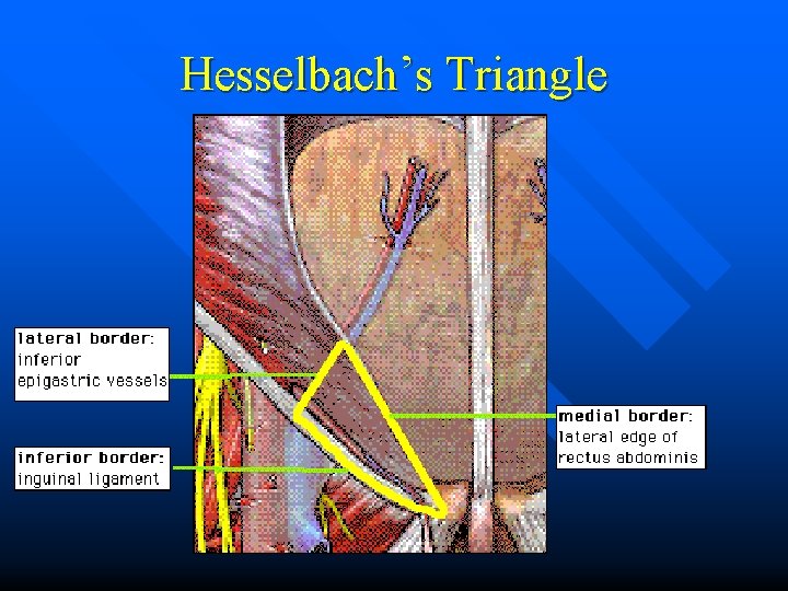Hesselbach’s Triangle 