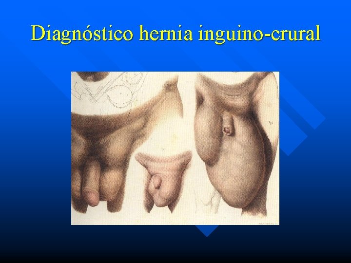 Diagnóstico hernia inguino-crural 