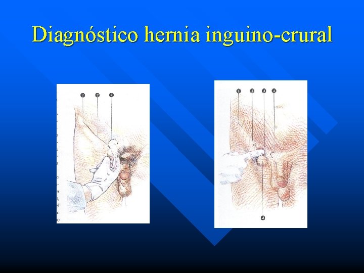 Diagnóstico hernia inguino-crural 