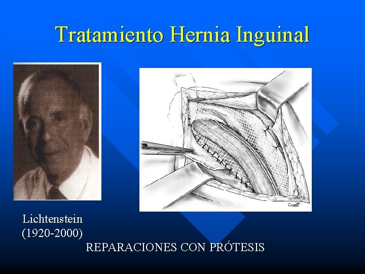 Tratamiento Hernia Inguinal Lichtenstein (1920 -2000) REPARACIONES CON PRÓTESIS 