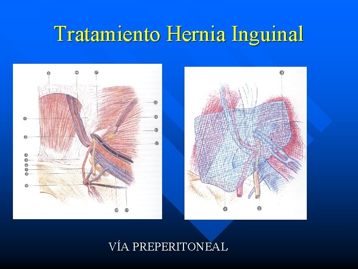 Tratamiento Hernia Inguinal VÍA PREPERITONEAL 