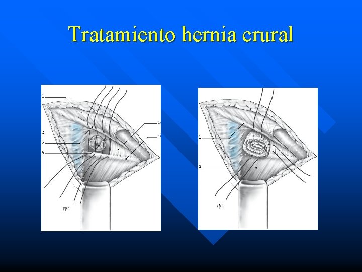 Tratamiento hernia crural 