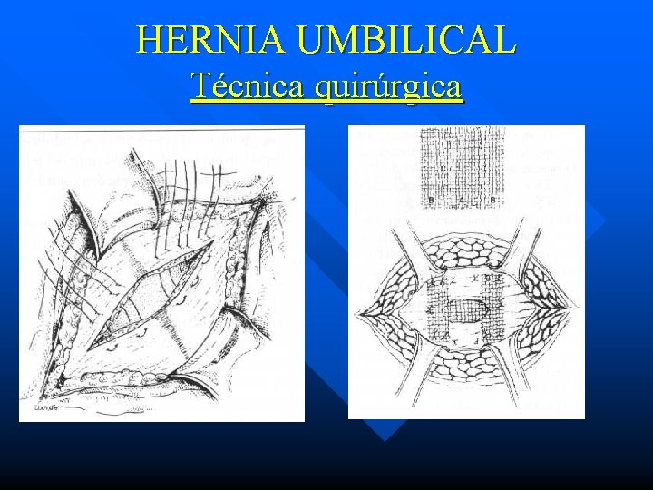 HERNIA UMBILICAL Técnica quirúrgica 