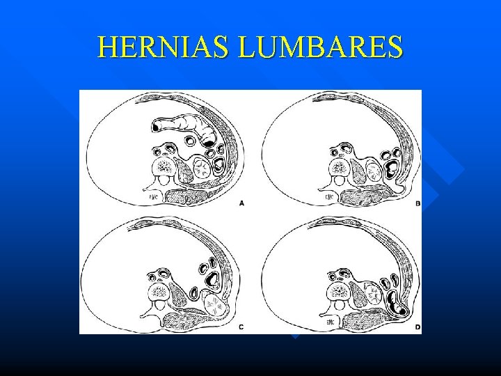 HERNIAS LUMBARES 