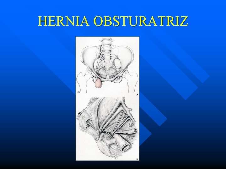 HERNIA OBSTURATRIZ 