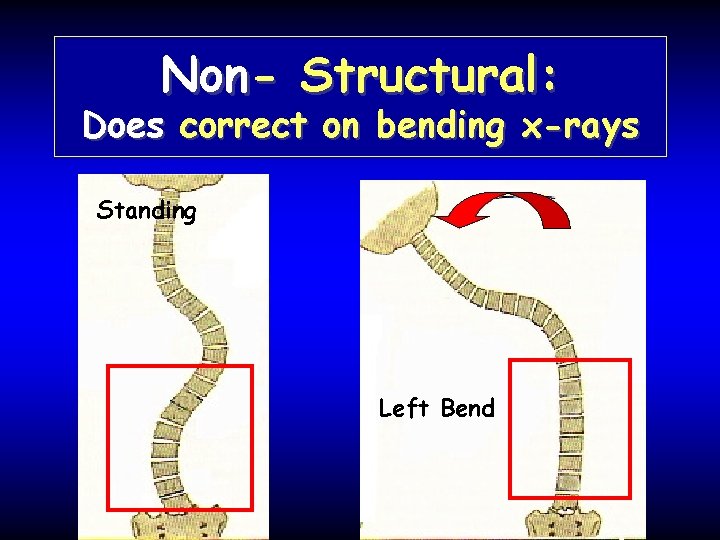 Non- Structural: Does correct on bending x-rays Standing Left Bend 